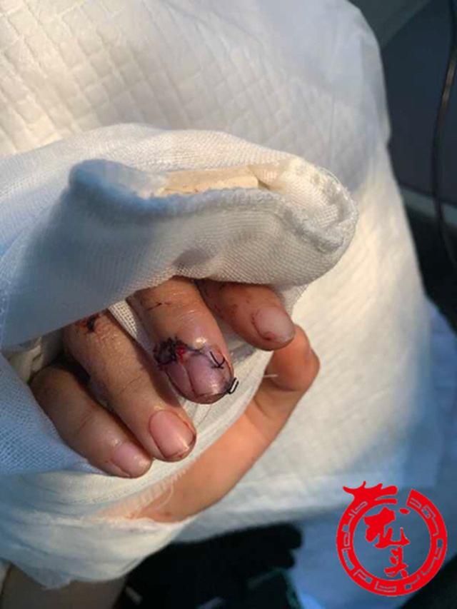  李佳明|女子操作机器不慎手指被切掉松子大一截