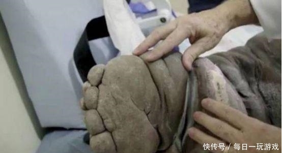  男子|男子只因20年前被蚊子叮了一下, 却要承受无尽的痛苦, 引人忧心