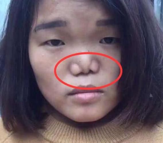 鼻孔|被公认的3种“丑鼻子”，中了颜值不会太高，没中的小可爱偷笑吧
