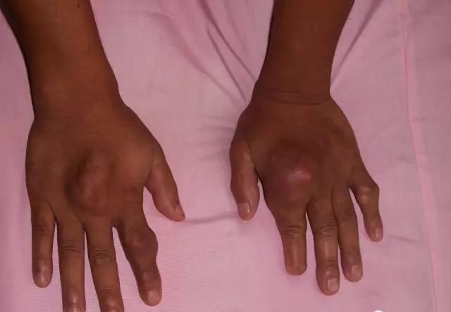 性关节炎|痛风——不是一种病,而是一串病