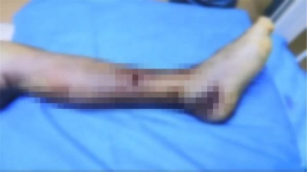  医院|惊！毒蛇溜进家，咬伤6岁孩子！这份自救常识能救命！