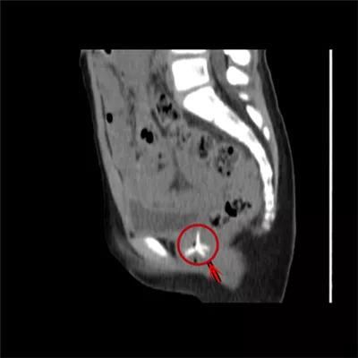  真相|有图有真相：那些年，孩子体内发现的硬币、钥匙、钉子、别针、电池……