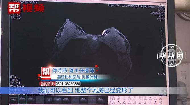 小婷|左乳皮肤潮红，一年内迅速扩散，发现时已是癌症晚期