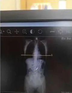  患者|杭州女子胃里惊现一只大勺子，14厘米长！原因竟是……