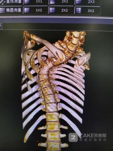  变形|22岁小伙“驼背”十余年 医生植入螺钉重塑变形脊柱