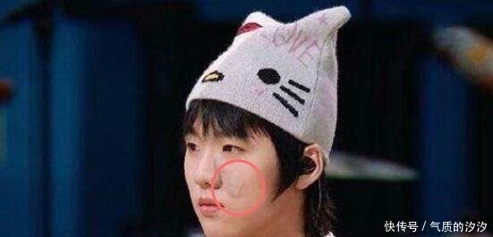 亲爱|《亲爱的自己》:林玲的扮演者陈卓璇,毫不掩饰的胎记是认真的吗