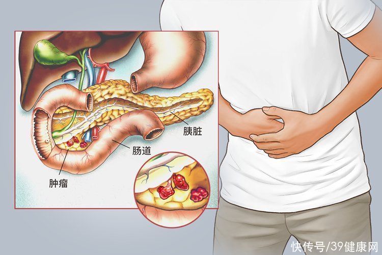 肠镜检查粪便常规检查能查出癌吗(男子大便带油花，反复检查肠镜正常，最终发现竟是癌中之王)