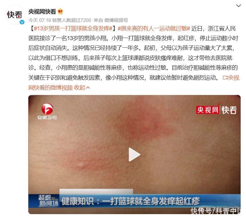打完球全身痒起红疹(真有人对运动过敏！打个球就全身发痒、起红疹，甚至头晕休克……)