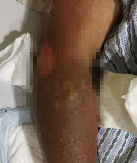  烫伤|地面62℃，杭州大伯摔倒后二度烫伤！网友晒出一张图，更扎心了