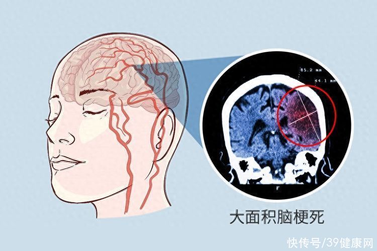 导致脑梗塞的厨房内四种调料滥用(为啥中国脑梗死患者越来越多？厨房里的3种调料滥用或是“帮凶”)