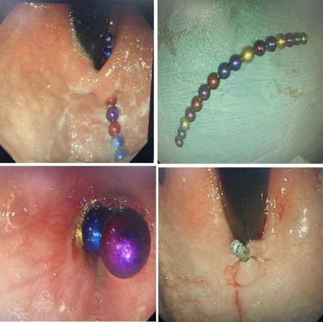  留置|济南一5岁女孩，误吞190颗巴克球，胃内留置俩月，胃镜全部取出后，医生惊呼奇迹……