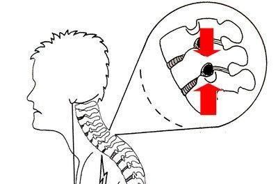  出或者骨赘|颈椎病是什么？医生：它分为7种类型，来看看你是哪一种