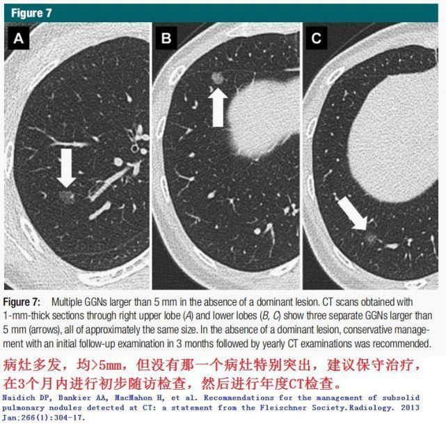  结节|肺结节切还是不切？20张经典图谱说明白了！