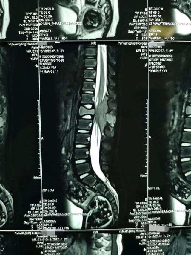  首儿|肿瘤像口香糖贴在硬脊膜上，首儿所为3岁女童重建脊梁
