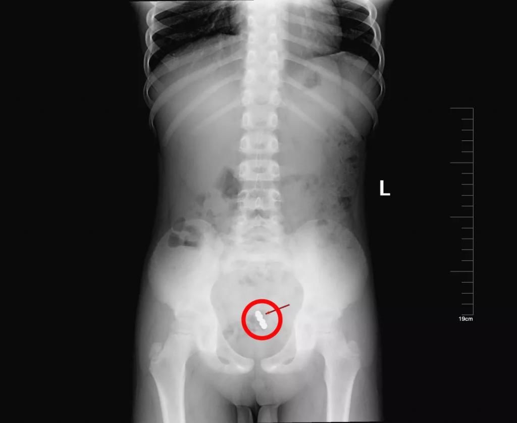  真相|有图有真相：那些年，孩子体内发现的硬币、钥匙、钉子、别针、电池……