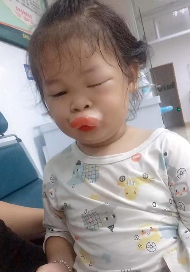 嘴巴|女儿吃芒果过敏,嘴巴2小时就肿成了“鸭子嘴”,亲妈笑出鹅叫声