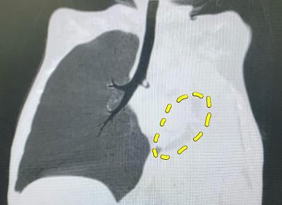  气管|四岁男童左肺“静止”一月，气管重建让肺“重启”