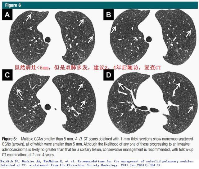 结节|肺结节切还是不切？20张经典图谱说明白了！
