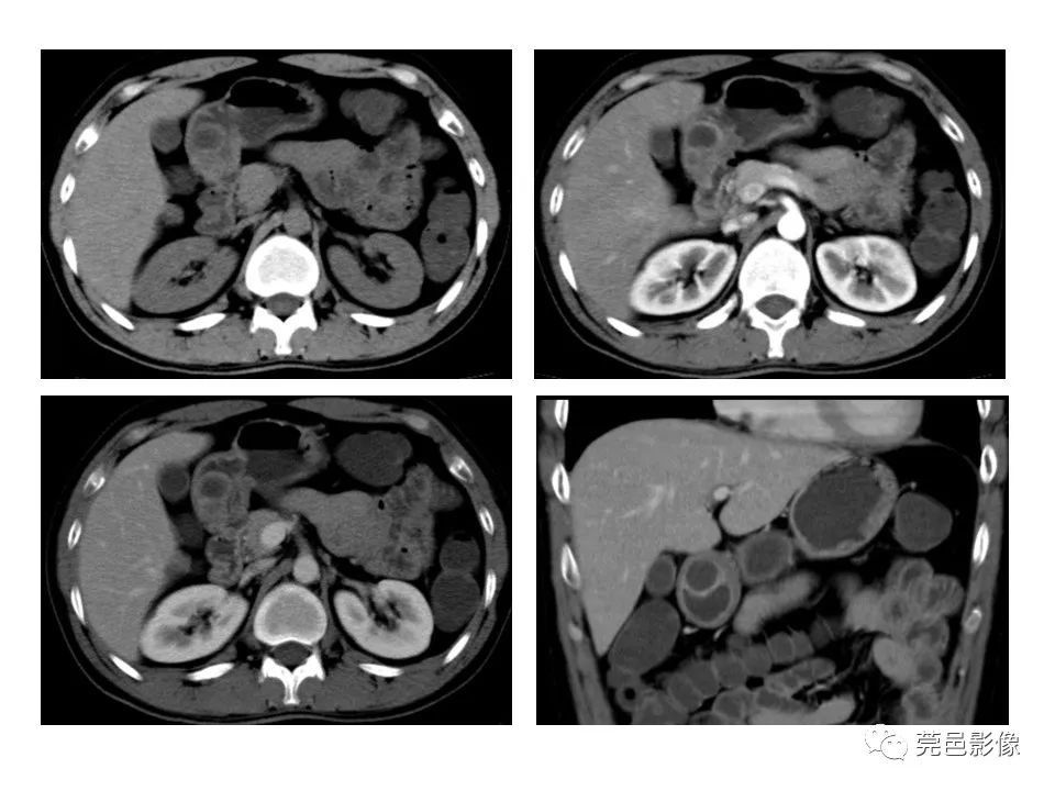 畸形|胃重复畸形CT诊断与鉴别诊断
