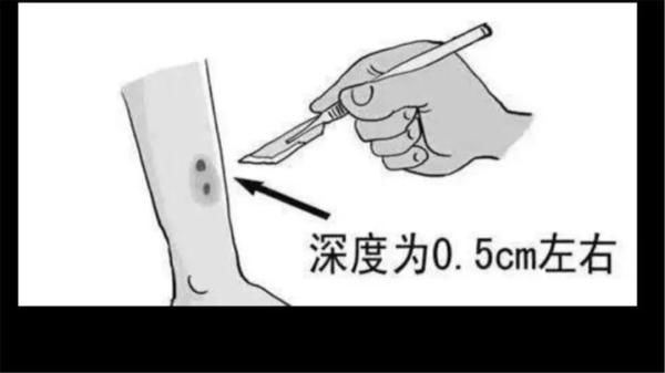  医院|惊！毒蛇溜进家，咬伤6岁孩子！这份自救常识能救命！