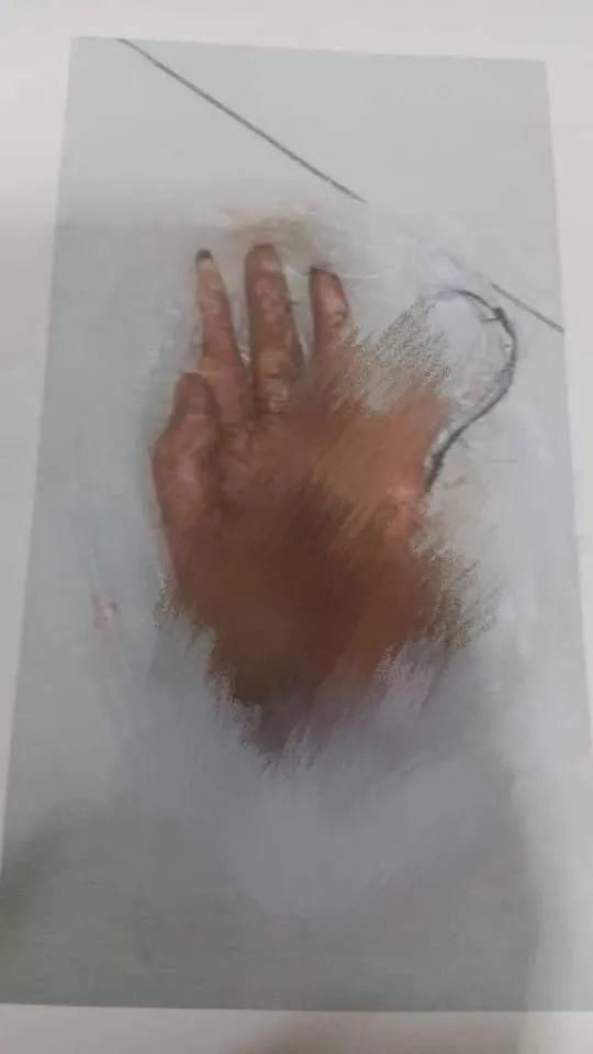 被捕|断人手掌并泼硫酸，一柬男子被捕归案