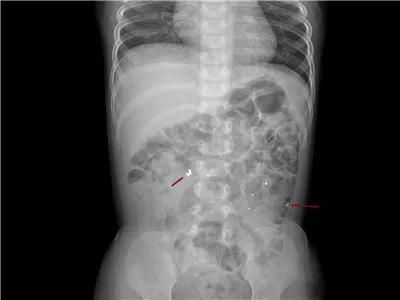  真相|有图有真相：那些年，孩子体内发现的硬币、钥匙、钉子、别针、电池……