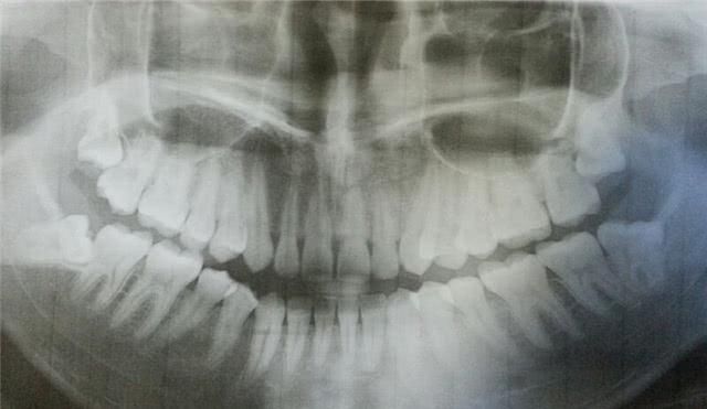  智齿|为什么拔出来的智齿会这么臭？听完医生的解释，觉得“难为情”