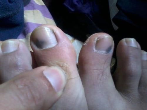  跑步|为什么很多人跑步后，都长出了“黑趾甲”？跟3种原因离不开