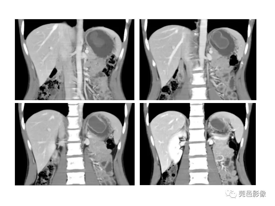 畸形|胃重复畸形CT诊断与鉴别诊断