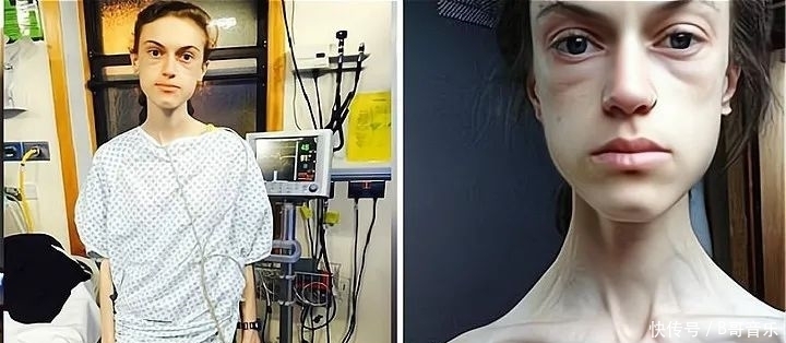 减肥|那个拼命减肥的女孩，后来为长肉拼命