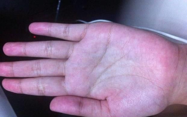 代谢|想知道自己的肝好不好只需“竖起中指”,看看就能知道了