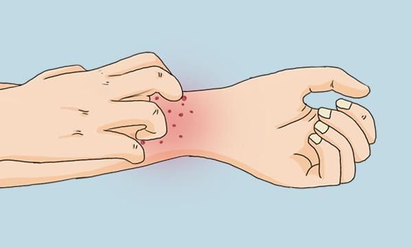  得了肝病|为什么肝病会引起皮肤瘙痒？肝病患者想要缓解瘙痒，需做什么？