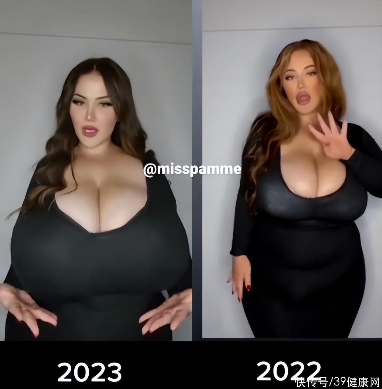 女的扁平胸怎么治疗(女子双胸重约25斤，确诊“巨乳症”！什么是巨乳症？怎么治疗？)