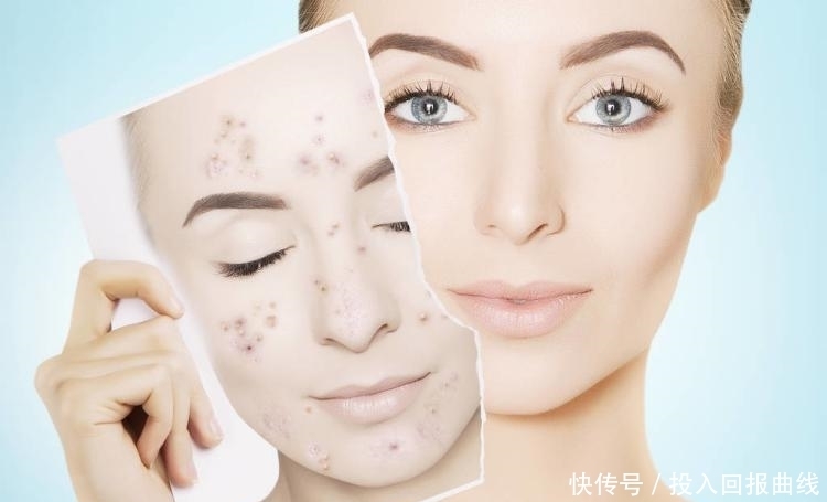  黑头|未成年人长黑头？只需要这样做！