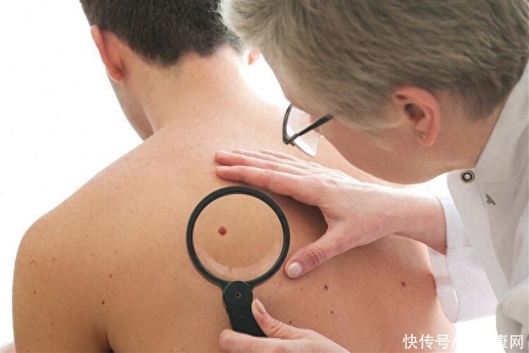 身上有红痣是肝病的前兆吗(身上长红痣，代表肝病来临？提醒：肝病变时，手脚可能有4种怪象)