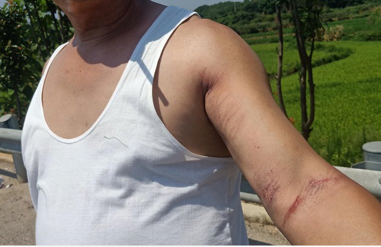  车祸|小车车祸撞变形，幸好司机做对了这件事……