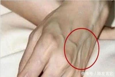 养肝护肝|“肝净”的人,手上一般会有3个“信号”,对照一下,你有几个