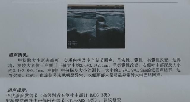 经典|经典问答：2mm甲状腺结节4类，边界不清，恶性概率有多高？