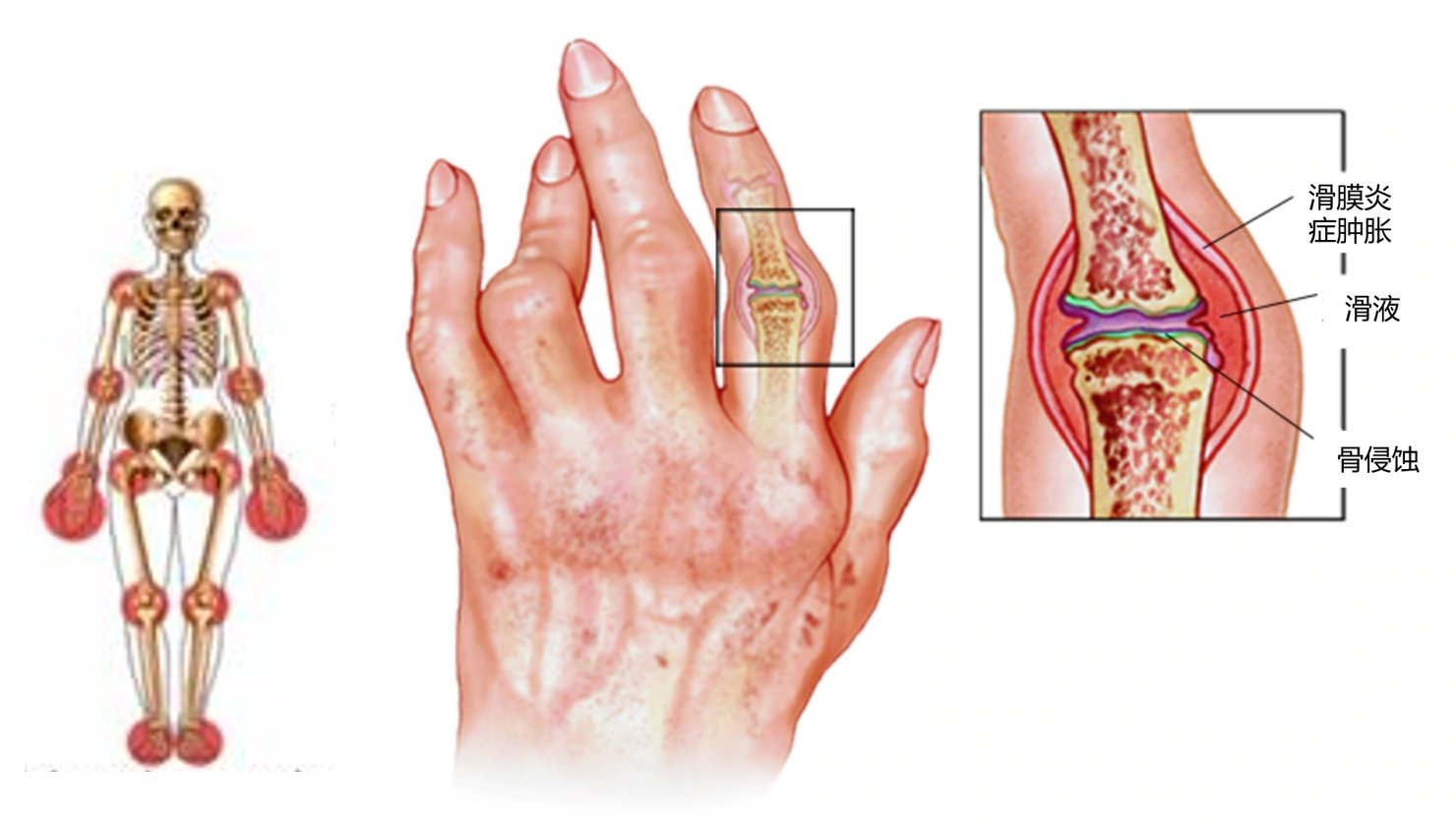  类风湿|风湿与类风湿有什么区别？类风湿的典型症状