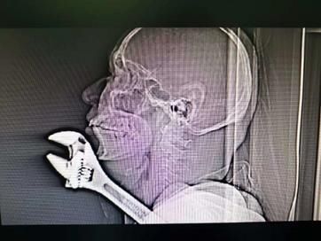 医生|惊险!工友不慎被扳手插入颈部 多学科医生合力抢救成功