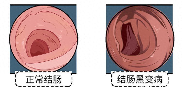 吃完饭就想上厕所是肠癌吗(一吃完饭就想上厕所，是肠癌预警吗？警惕上厕所时的3个异常)