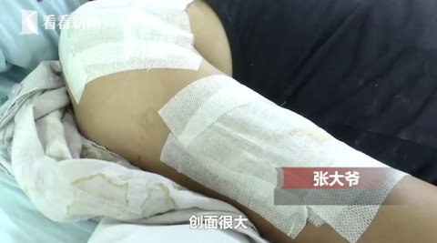  过路|秋田犬发狂连扑多人 过路大爷被咬到动脉