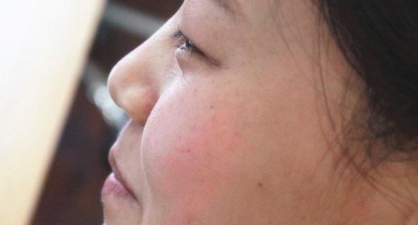  肝病|脸上长了很多黄褐斑，是肝病的前兆吗？得了肝病后