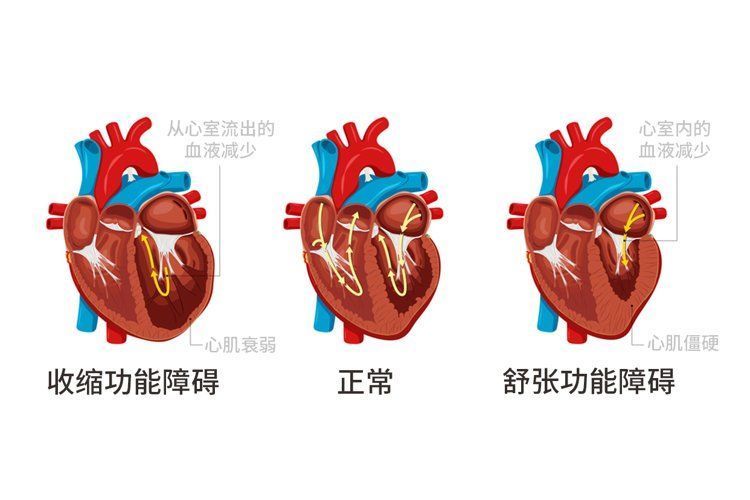 身体出现这5个信号，十有八九是心衰了，千万不要忽视，要谨慎2023