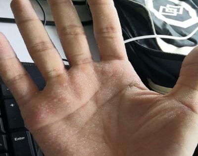  部位出汗|出汗部位的不同，是预示着什么呢？