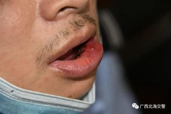  摩托车|摩托车“戴口罩”上路，交警制止违法被拖伤，疯狂少年被刑拘！