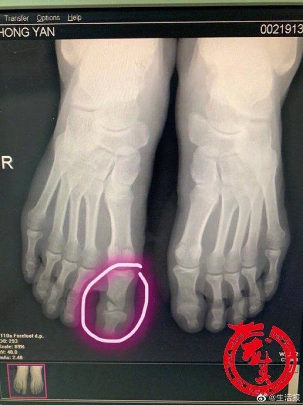  电锯|嫌家中板凳不平 男子拿起电锯，脚下一滑悲剧了