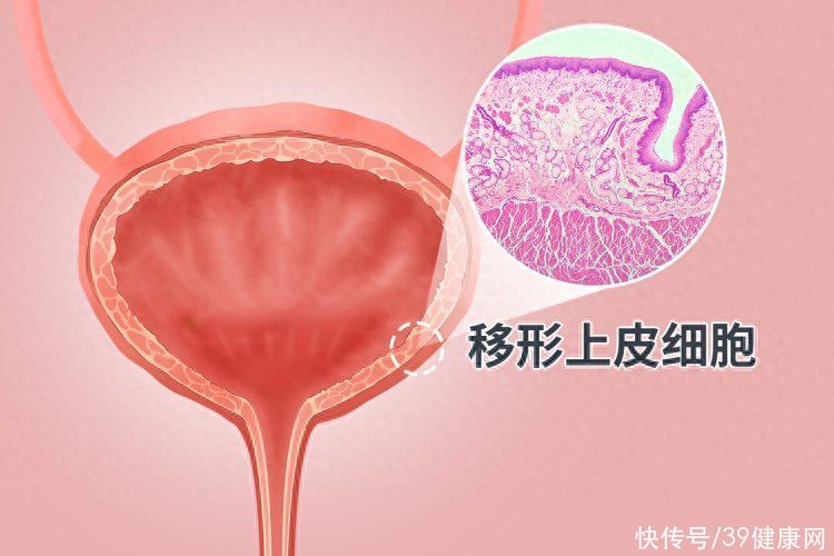 38岁男子因膀胱癌离世，提醒：小便时出现这3种异常，别疏忽大意2023