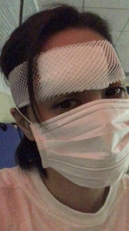 伤口|阿娇头部受伤照曝光，伤口6公分缝合10针，头包纱布神情憔悴