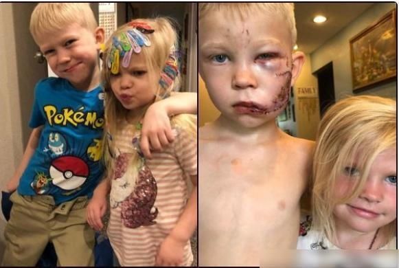  妹妹|美国6岁男孩保护妹妹与疯狗搏斗，缝90针笑容依旧，被绿巨人点赞